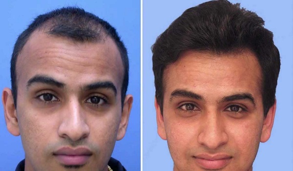 hair transplant in Delhi