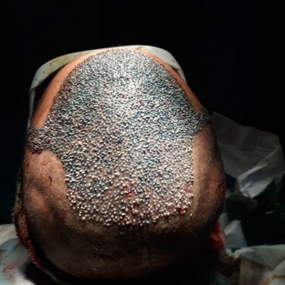 hair transplant