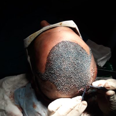 hair transplant