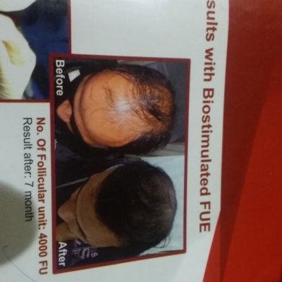 hair transplant before after