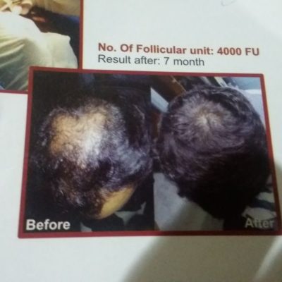 hair transplant before after