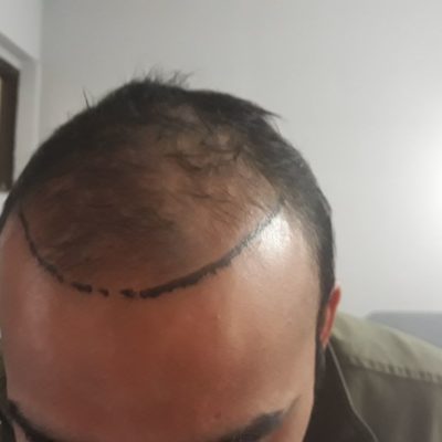 hair transplant