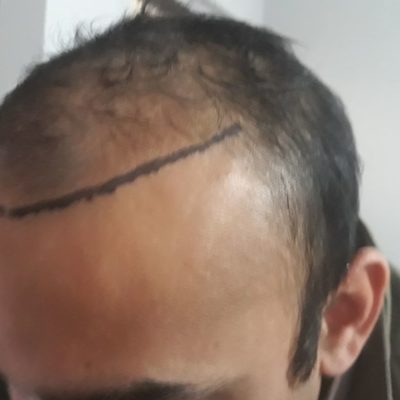 hair transplant